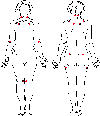 Fibromyalgia tender point locations diagram